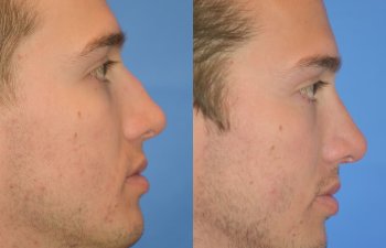 Male patient before and after rhinoplasty - right side
