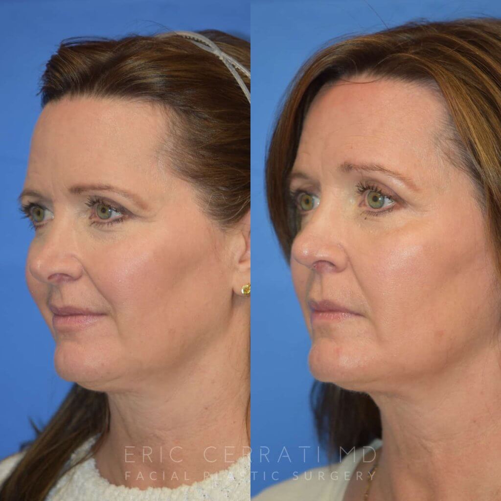 Female patient before and after rhinoplasty - left side