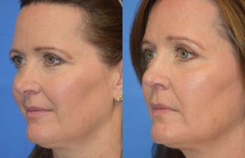 Female patient before and after rhinoplasty - left side
