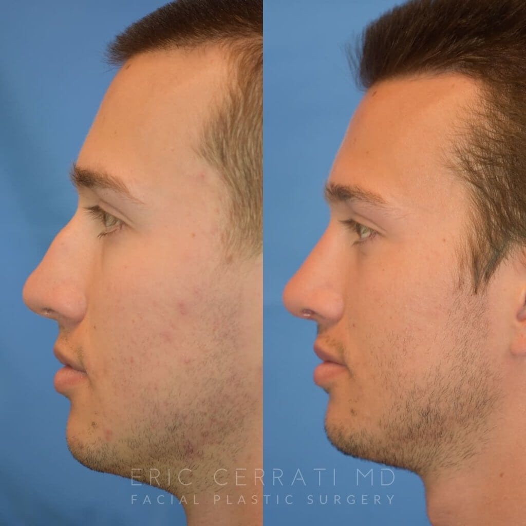 Male patient before and after rhinoplasty - left side