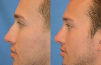 Male patient before and after rhinoplasty - left side