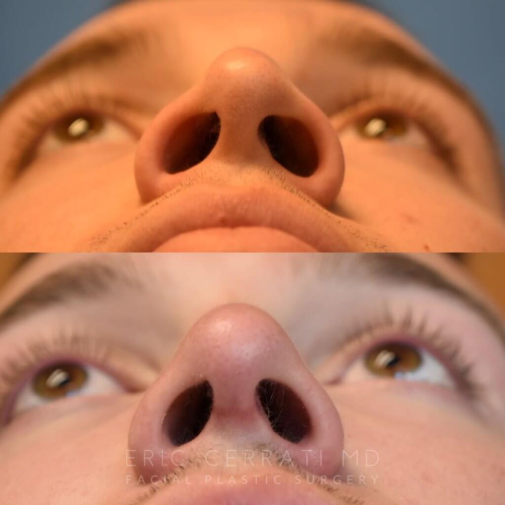 Male patient before and after rhinoplasty - front