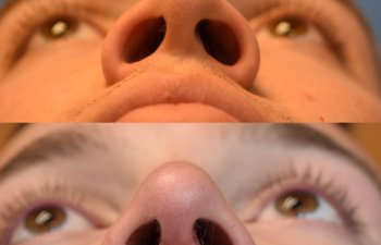 Male patient before and after rhinoplasty - front