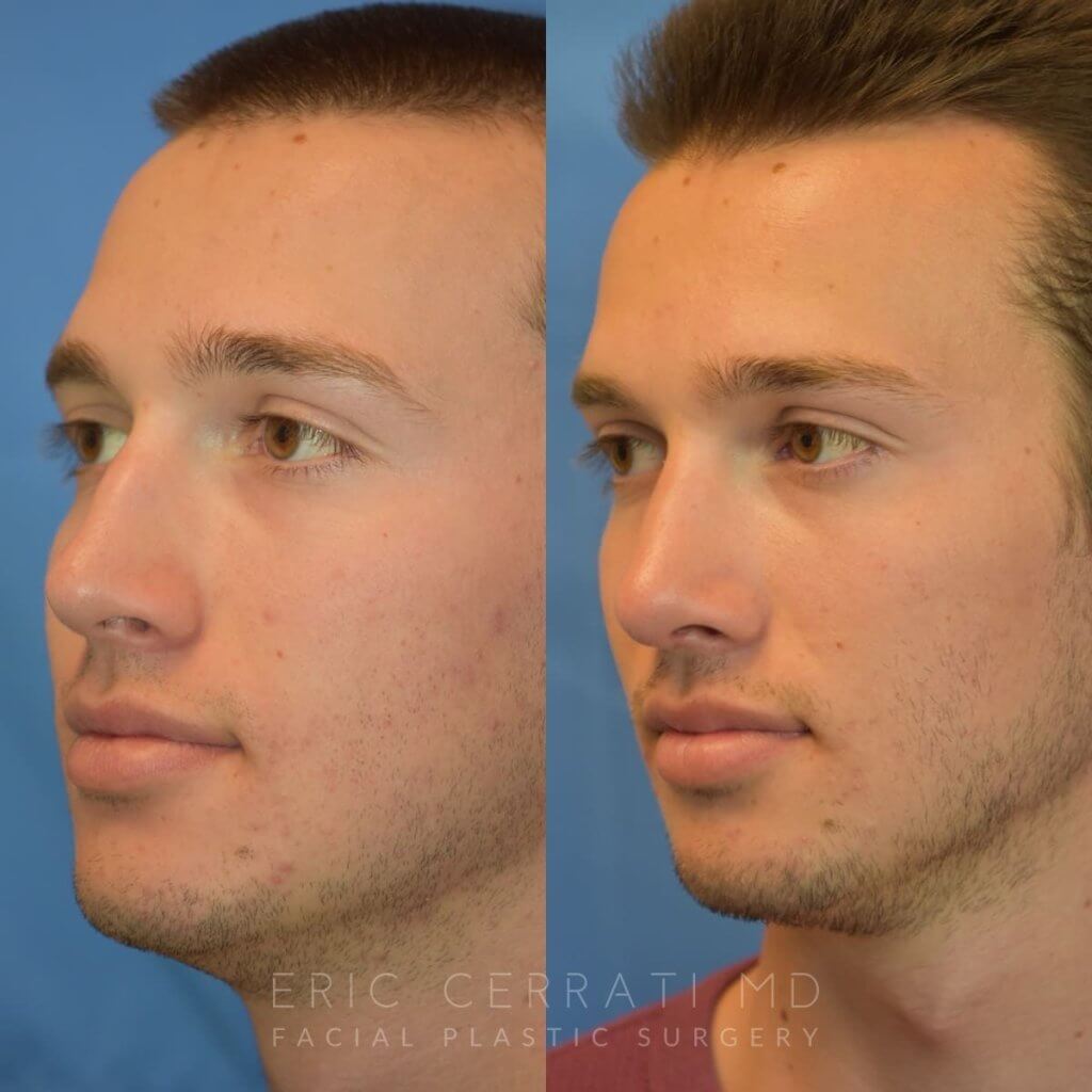 Male patient before and after rhinoplasty - left side
