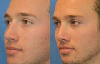 Male patient before and after rhinoplasty - left side