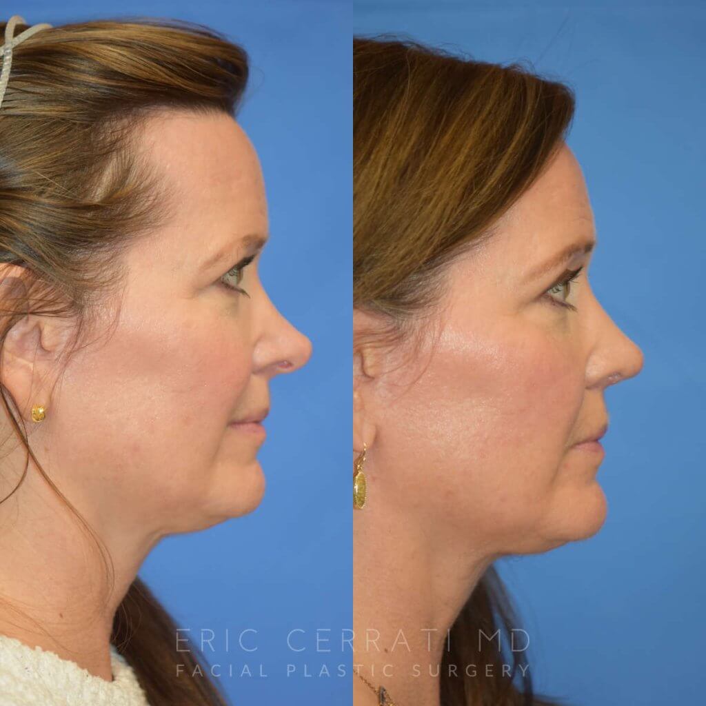 Female patient before and after rhinoplasty - right side