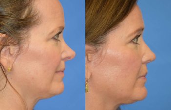 Female patient before and after rhinoplasty - right side