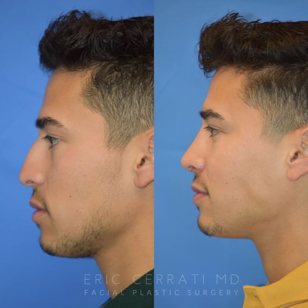 Male patient before and after rhinoplasty - front