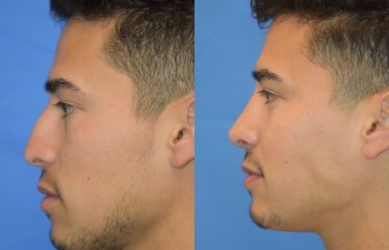 Male patient before and after rhinoplasty - front