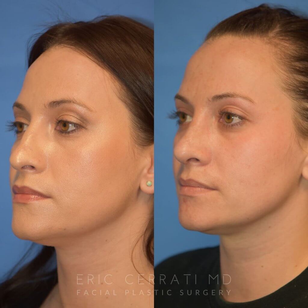 Female patient before and after rhinoplasty - left side