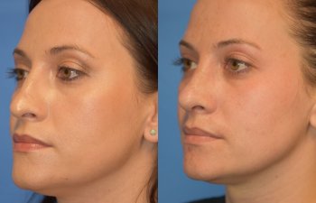 Female patient before and after rhinoplasty - left side