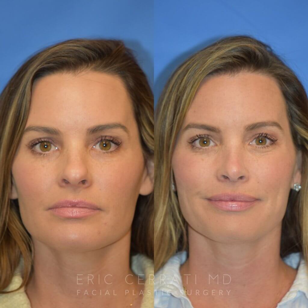 Female patient before and after rhinoplasty - front