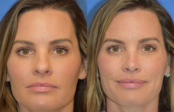 Female patient before and after rhinoplasty - front