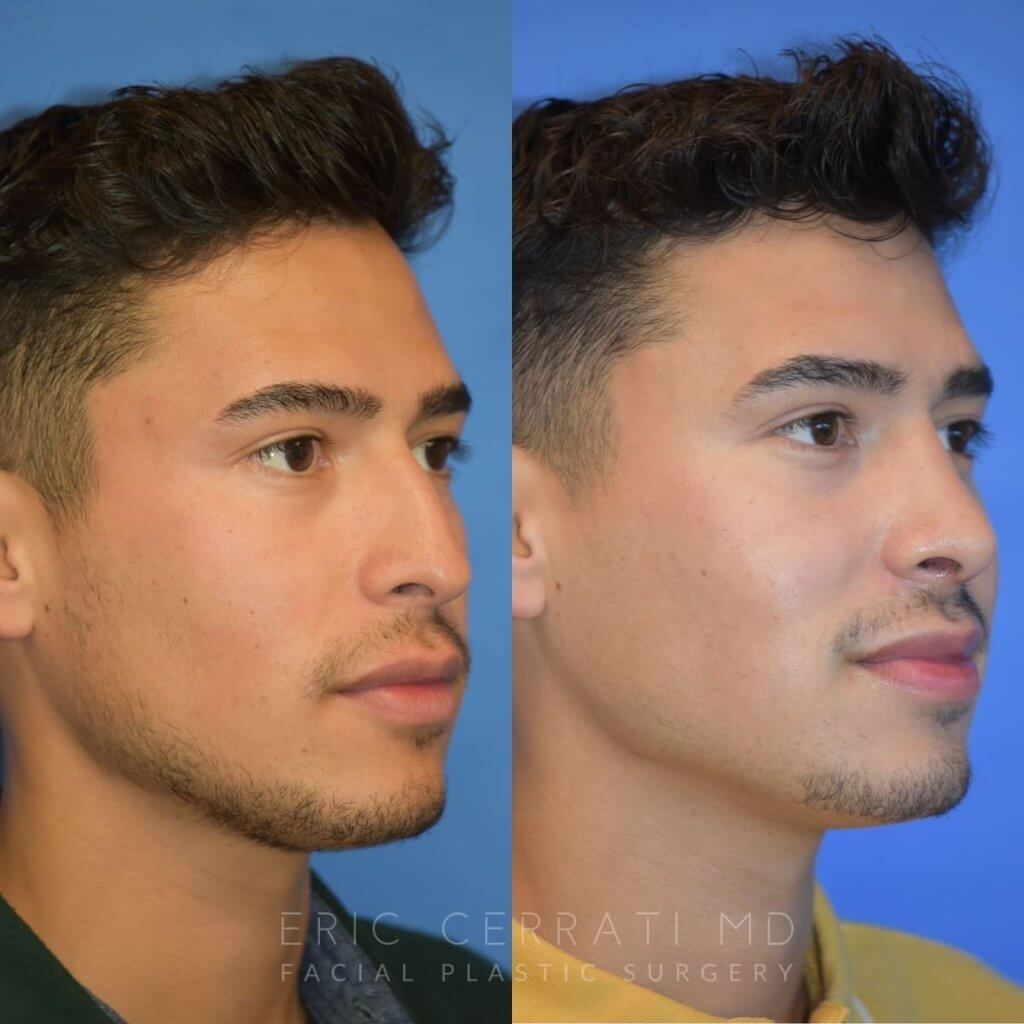 Male patient before and after rhinoplasty - front