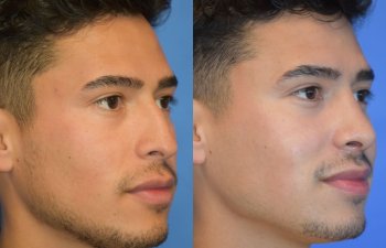Male patient before and after rhinoplasty - front