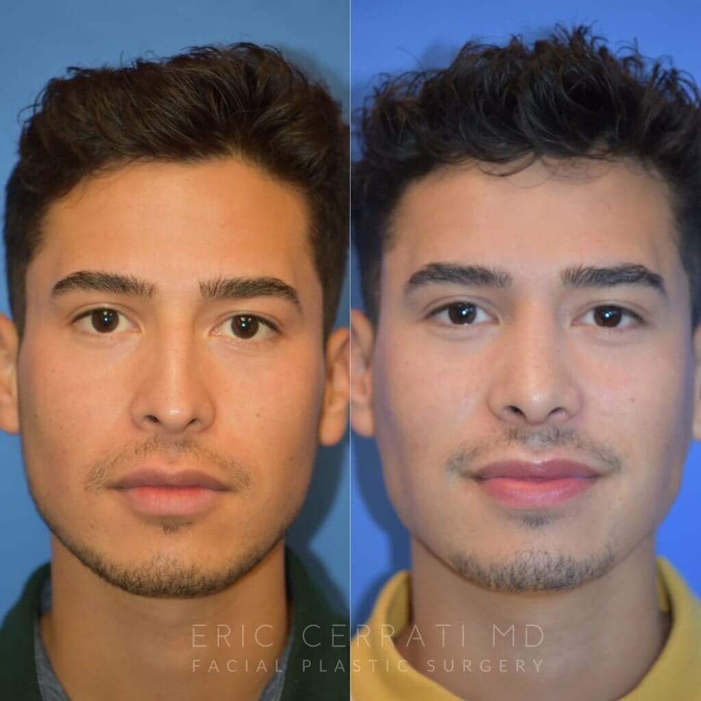 Male patient before and after rhinoplasty - front