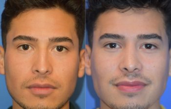 Male patient before and after rhinoplasty - front