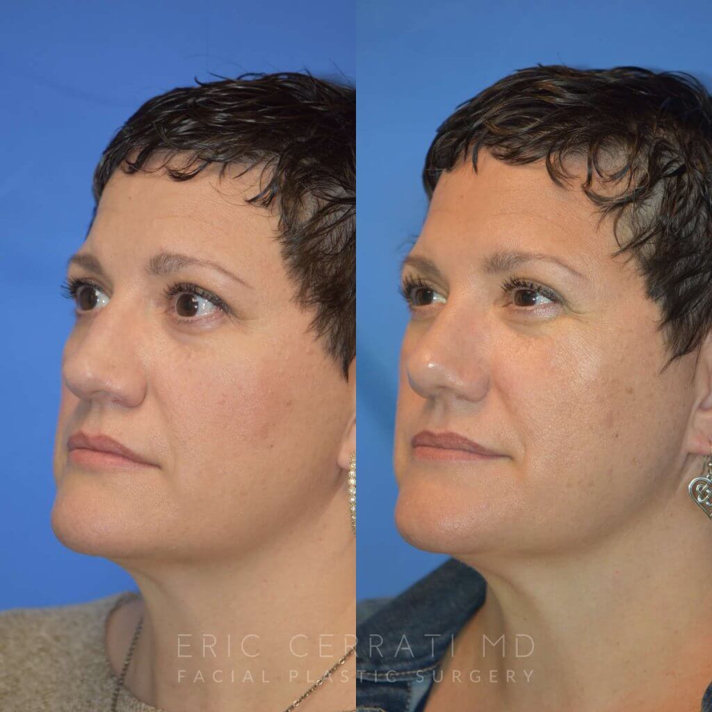 Female patient before and after rhinoplasty - left side