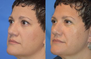 Female patient before and after rhinoplasty - left side