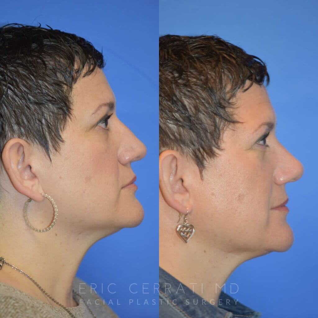 Female patient before and after rhinoplasty - right side