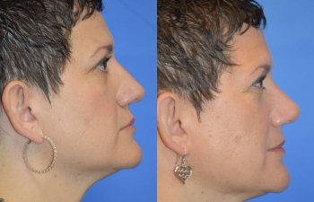 Female patient before and after rhinoplasty - right side