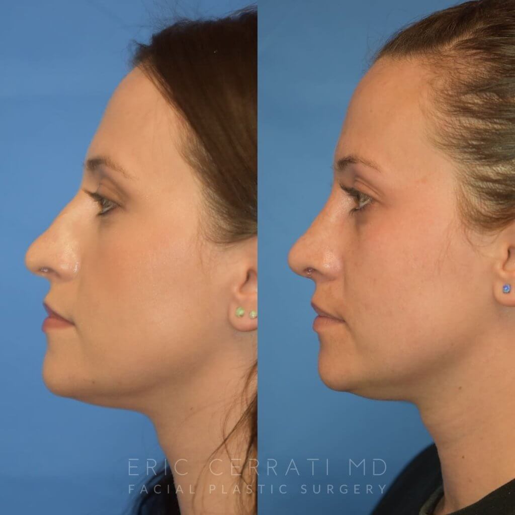 Female patient before and after rhinoplasty - left side