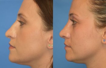 Female patient before and after rhinoplasty - left side