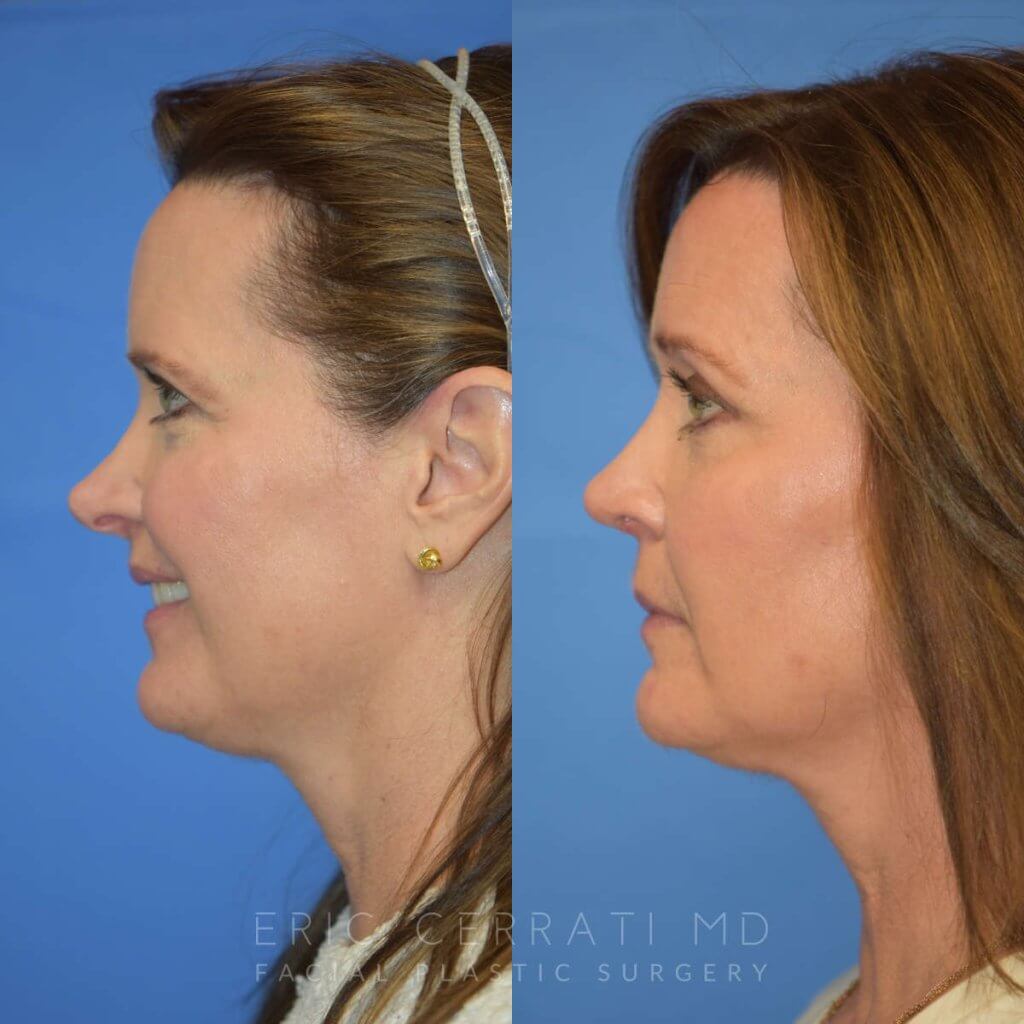 Female patient before and after rhinoplasty - left side