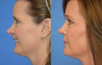 Female patient before and after rhinoplasty - left side