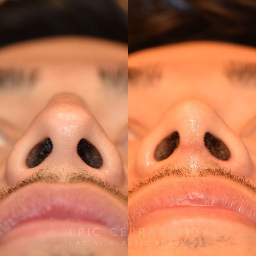 Male patient before and after rhinoplasty - front