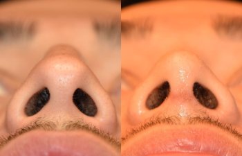 Male patient before and after rhinoplasty - front