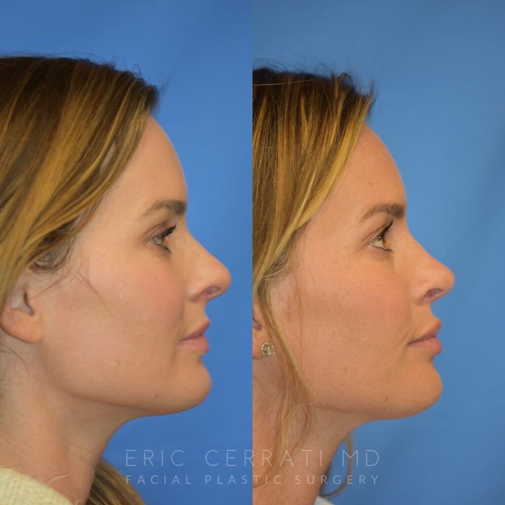 Female patient before and after rhinoplasty - right side