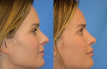 Female patient before and after rhinoplasty - right side