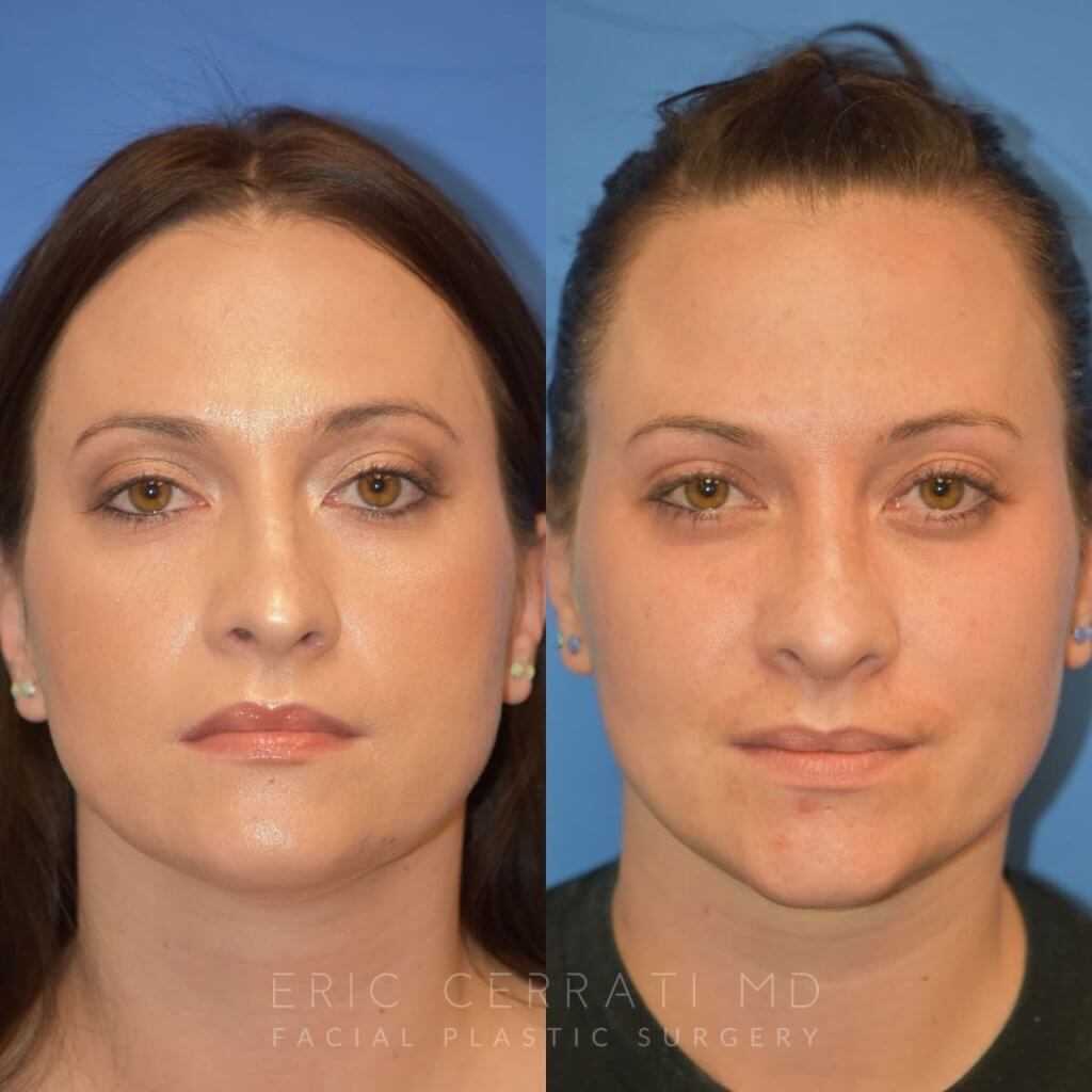 Female patient before and after rhinoplasty - front