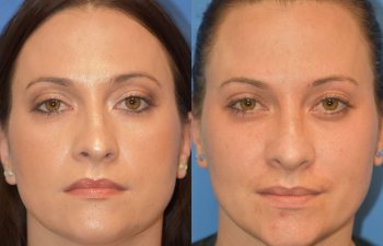 Female patient before and after rhinoplasty - front