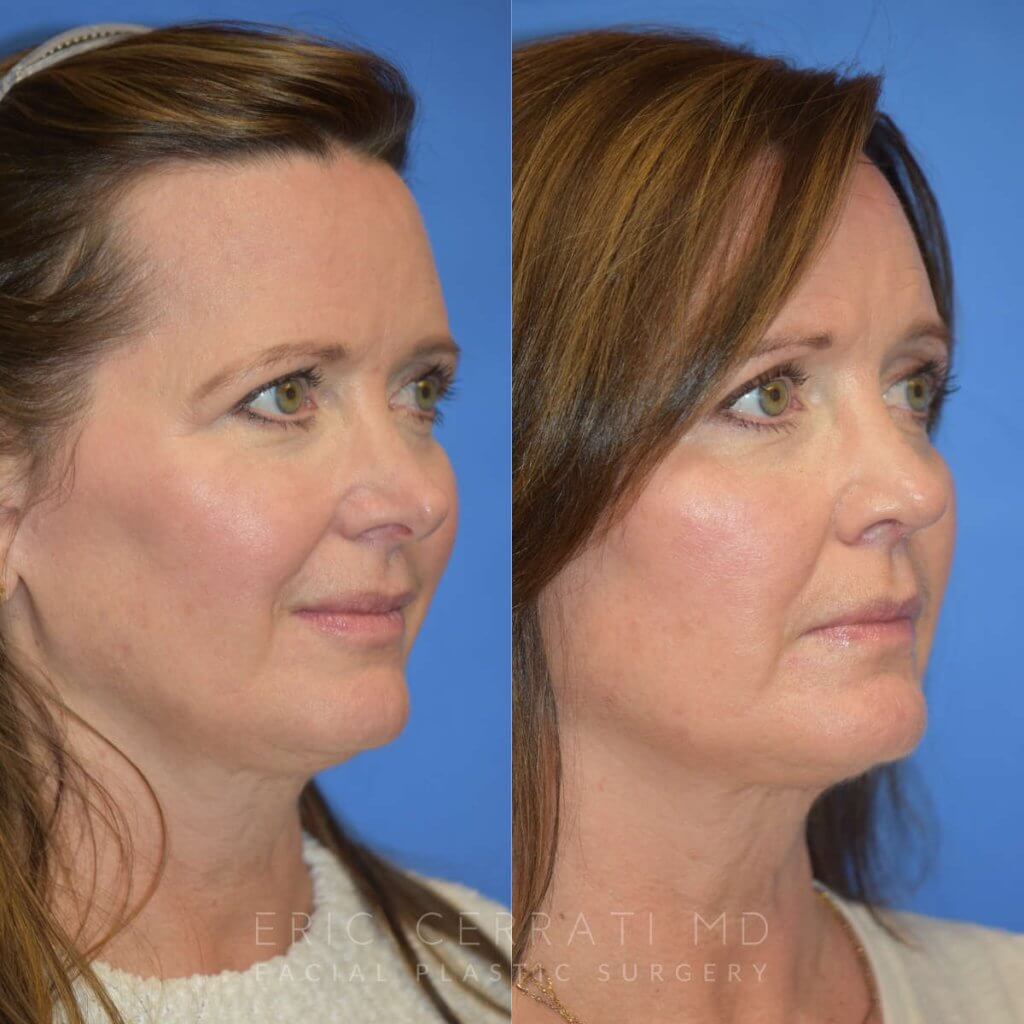 Female patient before and after rhinoplasty - right side