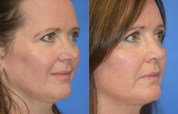Female patient before and after rhinoplasty - right side