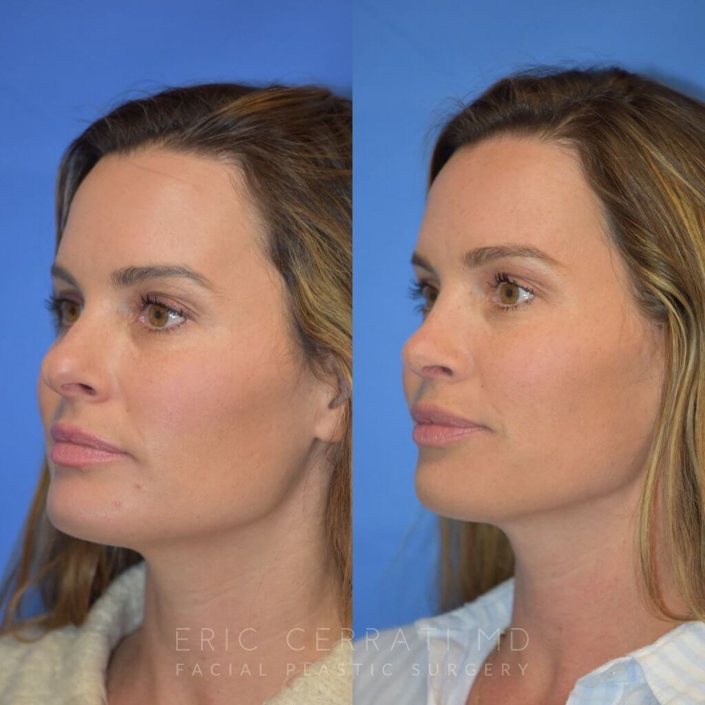 Female patient before and after rhinoplasty - left side