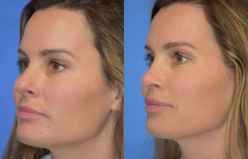 Female patient before and after rhinoplasty - left side