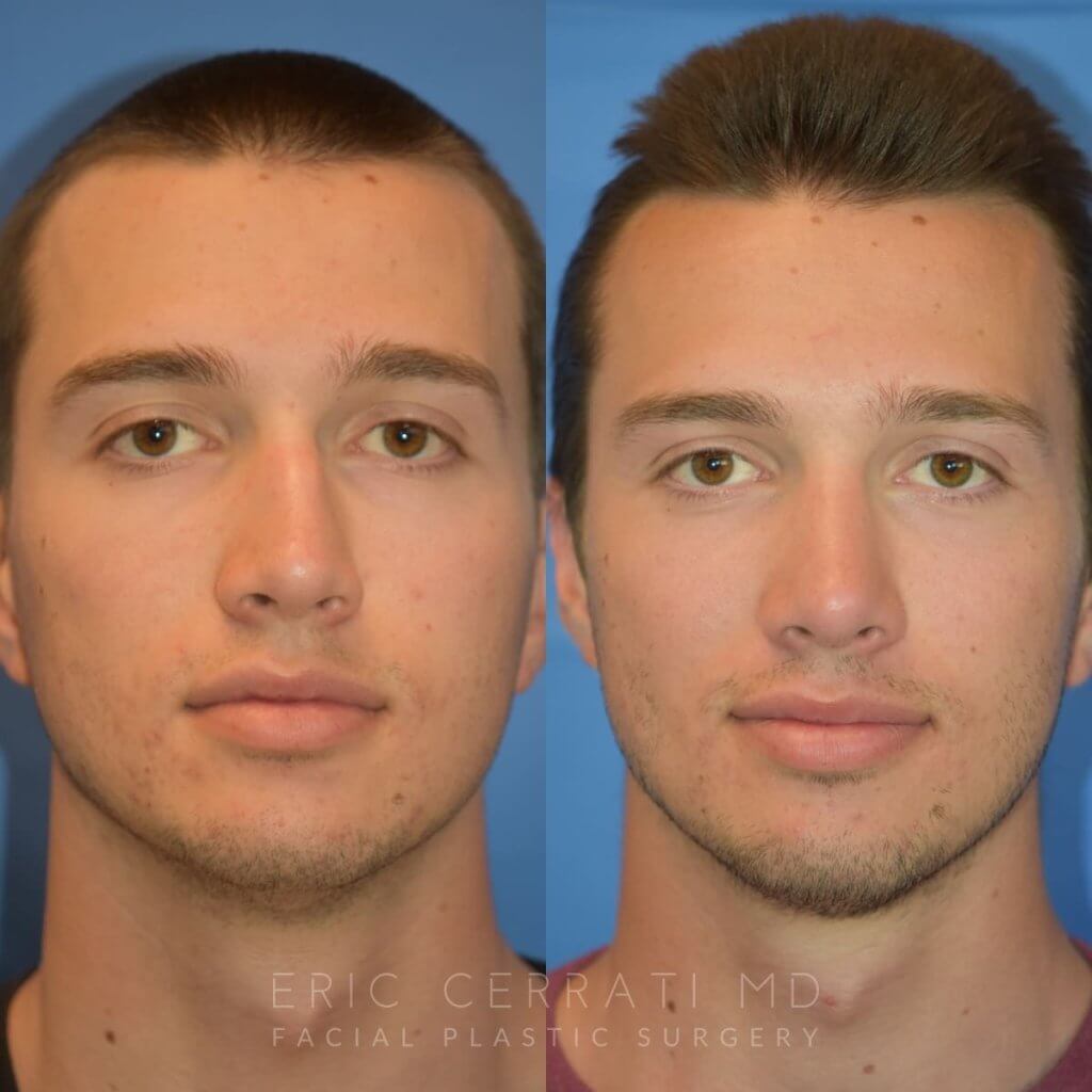 Male patient before and after rhinoplasty - front