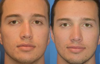 Male patient before and after rhinoplasty - front