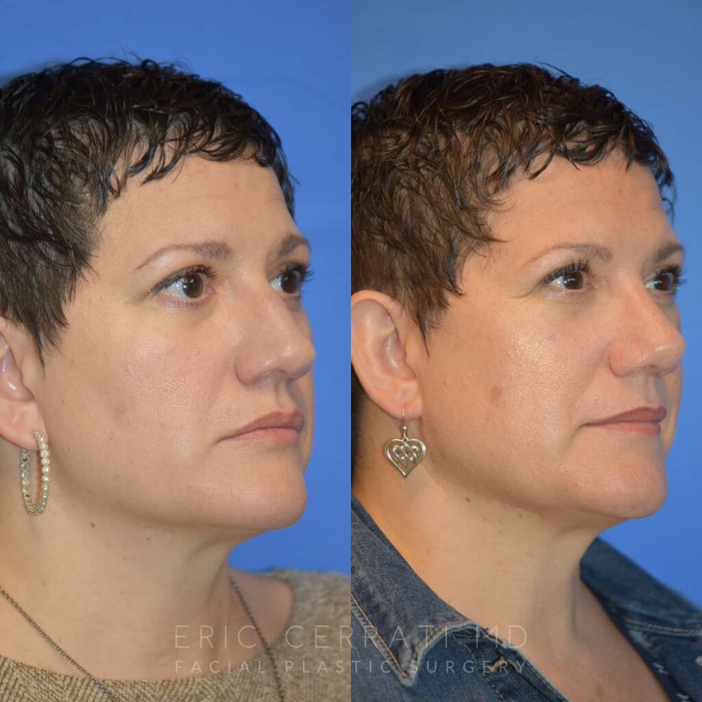 Female patient before and after rhinoplasty - right side
