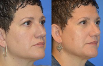 Female patient before and after rhinoplasty - right side