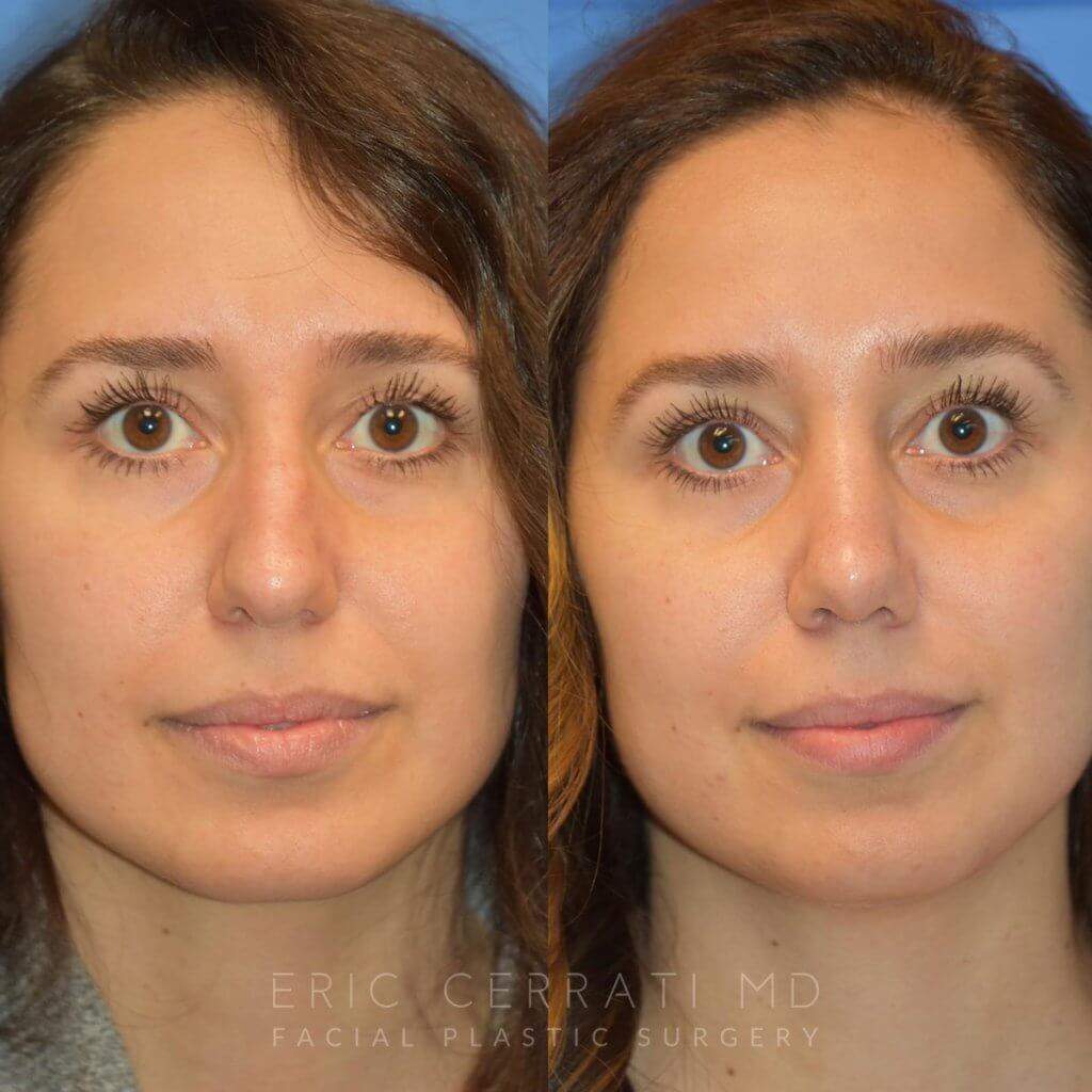 Female patient before and after rhinoplasty - front