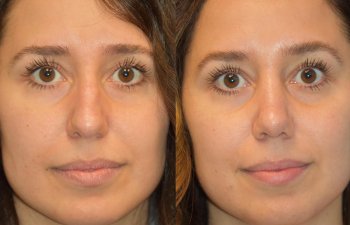 Female patient before and after rhinoplasty - front