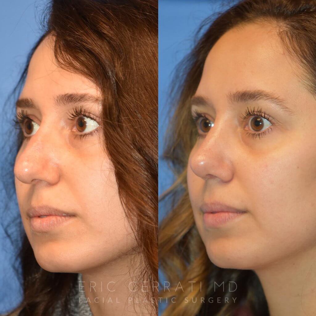 Female patient before and after rhinoplasty - front side