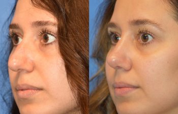 Female patient before and after rhinoplasty - front side