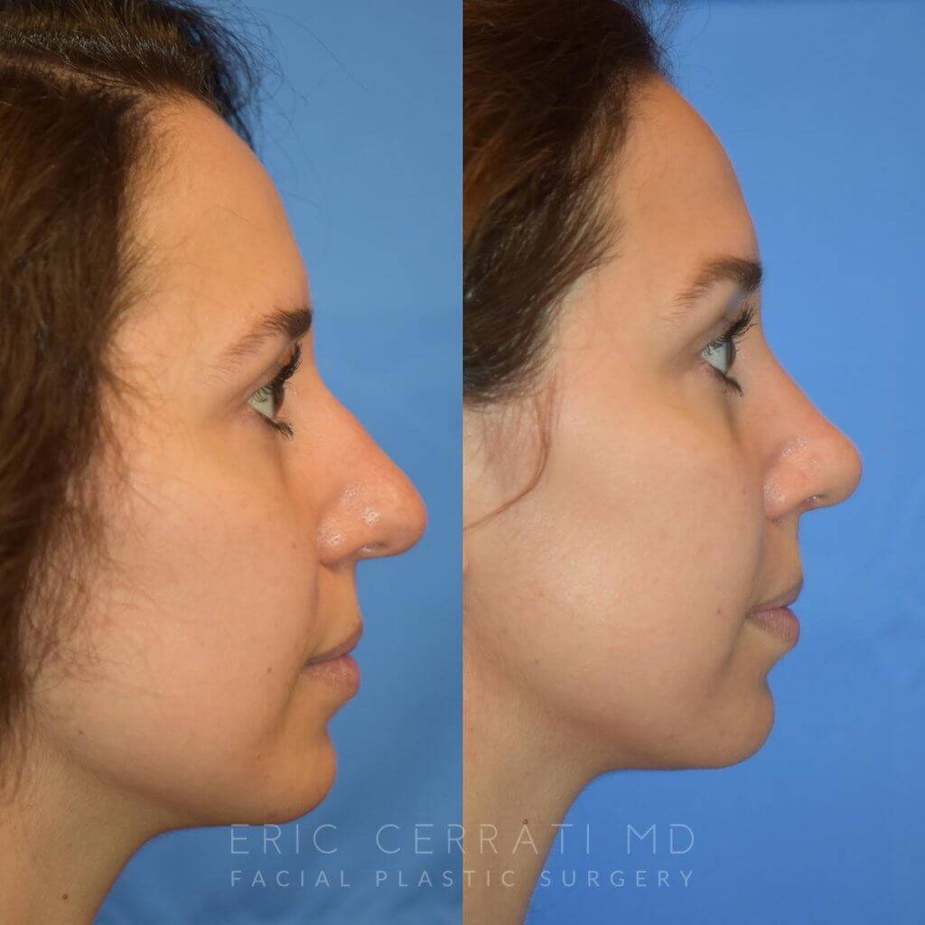 Female patient before and after rhinoplasty - right side