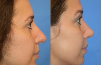 Female patient before and after rhinoplasty - right side