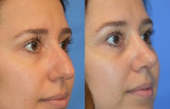 Female patient before and after rhinoplasty - right side